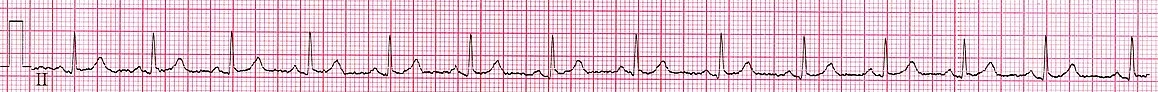 Extrait de la dérivation II du même ECG, montrant une succession de cycles électriques.