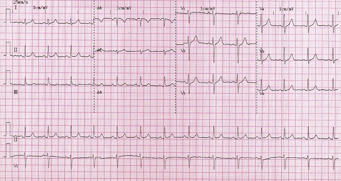 Exemple réel d’ECG : douze dérivations et bandes de rythme, imprimées sur un quadrillage rose.