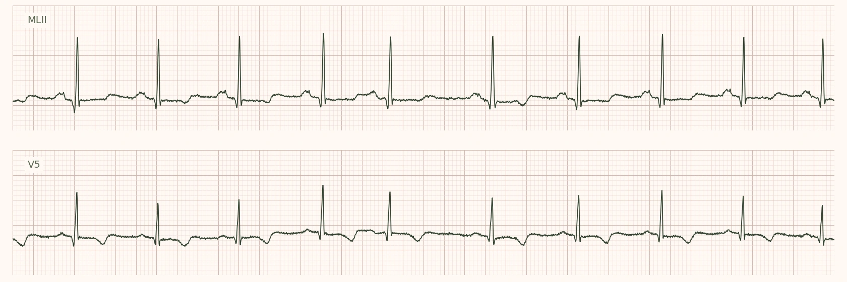 Deux canaux d’un véritable ECG ambulatoire sur huit secondes, issus de la base publique MIT-BIH. Extrait pédagogique sans interprétation diagnostique.